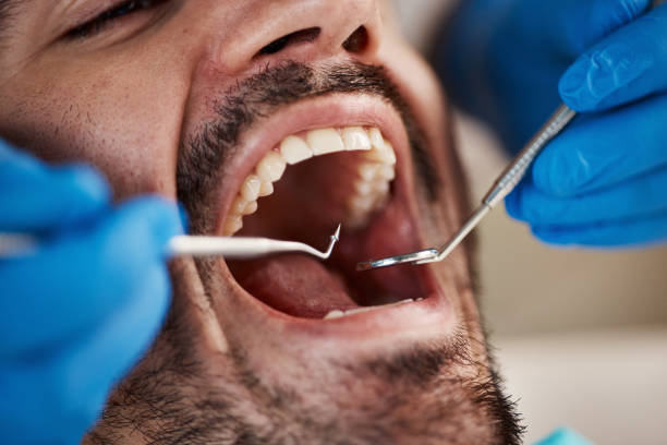 Best Emergency Wisdom Tooth Extraction in Dunedin, FL